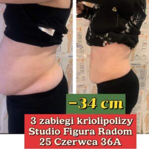Kriolipoliza